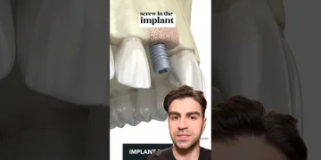 Tooth Implant Procedure {STEP BY STEP} - Explained | Pinoy dental care