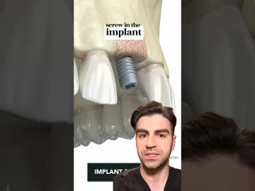Tooth Implant Procedure {STEP BY STEP} - Explained | Pinoy dental care