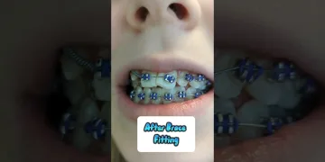 Before and After Brace Fitting Appointment #shorts #braces | Pinoy dental care