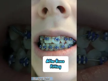 Before and After Brace Fitting Appointment #shorts #braces | Pinoy dental care