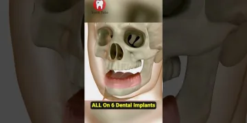 All On 6 Dental Implants #shorts | Pinoy dental care
