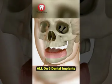 All On 6 Dental Implants #shorts | Pinoy dental care