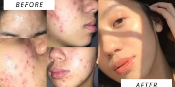How I Cleared My Acne Prone Skin!! (acne journey + products I used) | Pinay acne journey
