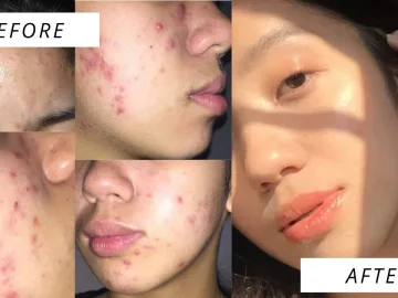 How I Cleared My Acne Prone Skin!! (acne journey + products I used) | Pinay acne journey